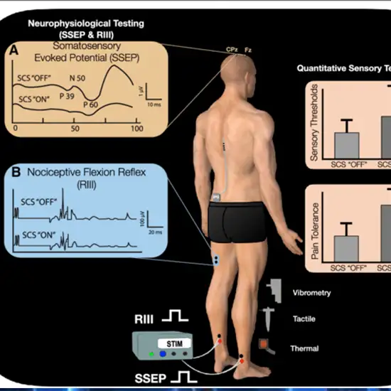 SSEP Study (Upper Limbs) – KEDC HEALTHCARE PVT LTD